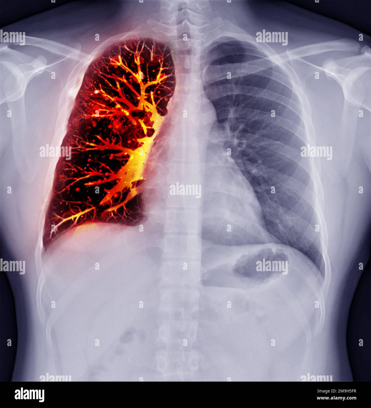 Fusion image of Chest xray and CT Chest Coronal view for lung