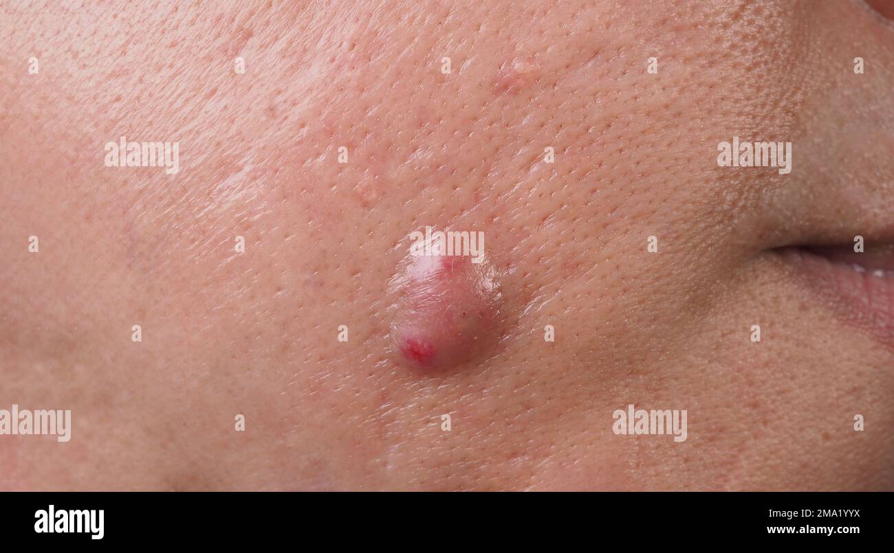Bacterial skin infection. Big Acne Cyst Abscess or Ulcer Swollen area