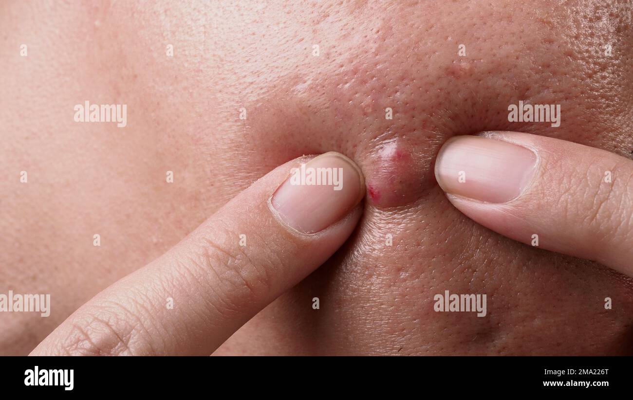 Abscess hi-res stock photography and images - Page 6 - Alamy Abscess hi-res stock photography and images - Page 6 - Alamy