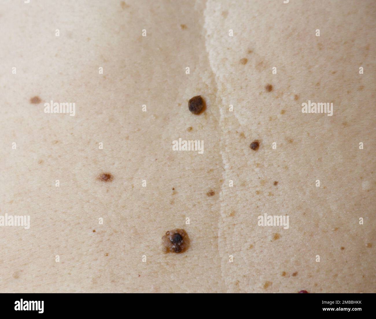 Image of part a woman's back with melanoma and seborrheic keratosis Stock Photo