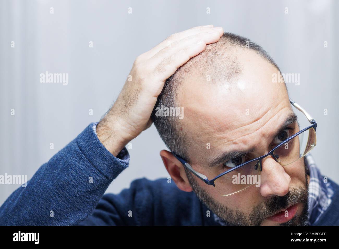 Young man with alopecia looking at his head and hair in the mirror Stock Photo