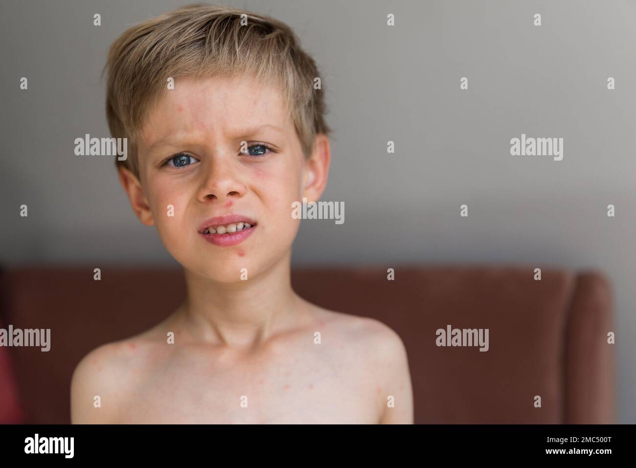 Young toddler with chickenpox. Sick child with chickenpox. Varicella