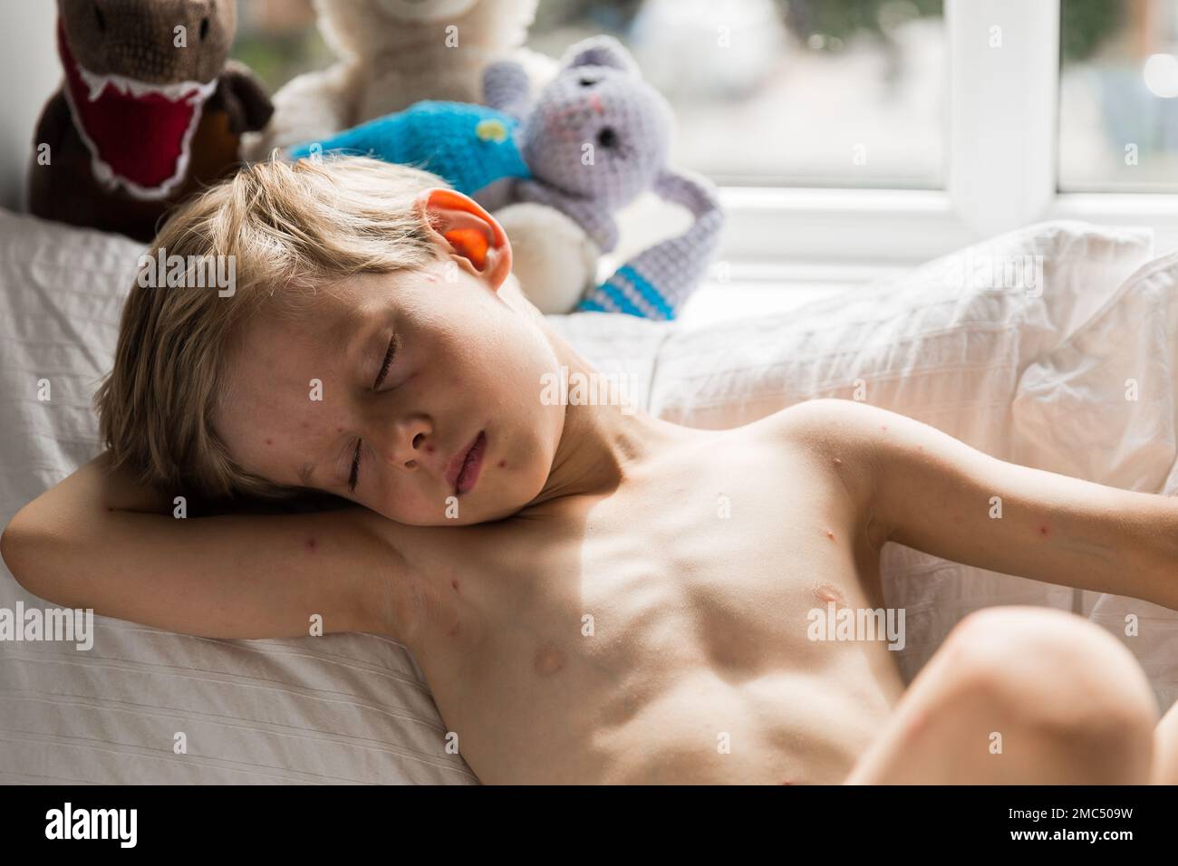 Young toddler with chickenpox. Sick child with chickenpox. Varicella virus or Chickenpox bubble rash on child. Portrait of little boy with pox. Stock Photo