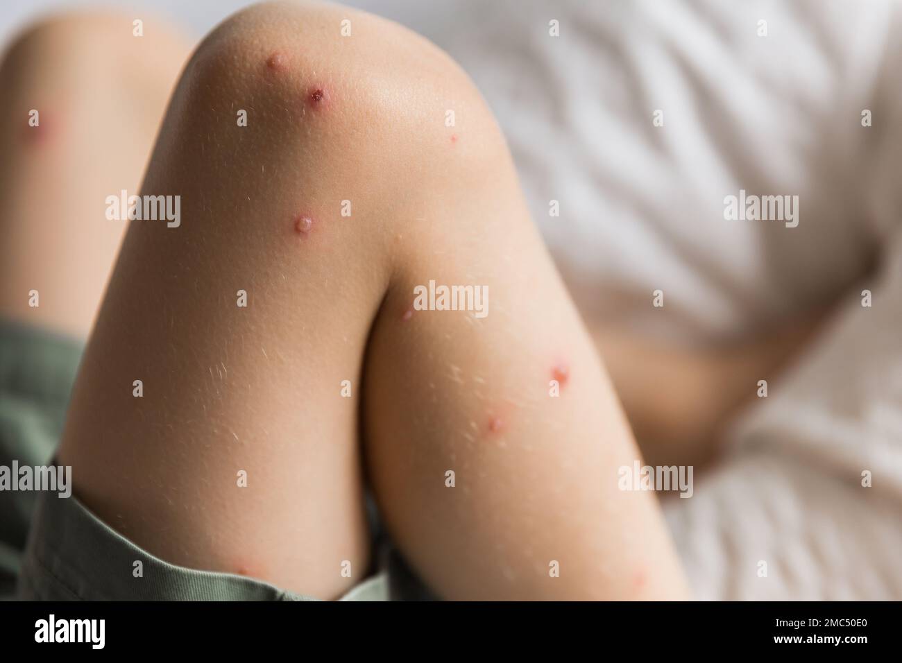 Young toddler with chickenpox. Sick child with chickenpox. Varicella virus or Chickenpox bubble rash on child. Portrait of little boy with pox. Stock Photo