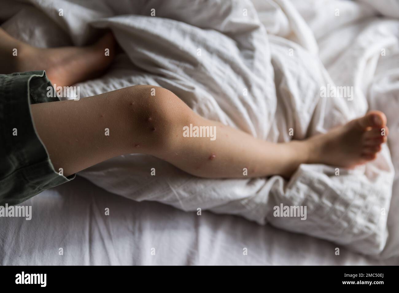 Young toddler with chickenpox. Sick child with chickenpox. Varicella ...