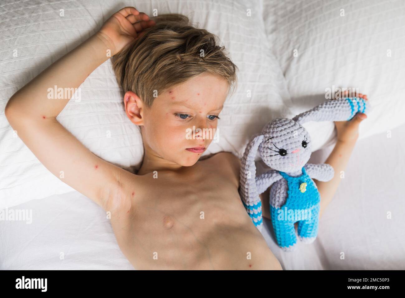 Young toddler with chickenpox. Sick child with chickenpox. Varicella virus or Chickenpox bubble rash on child. Portrait of little boy with pox. Stock Photo