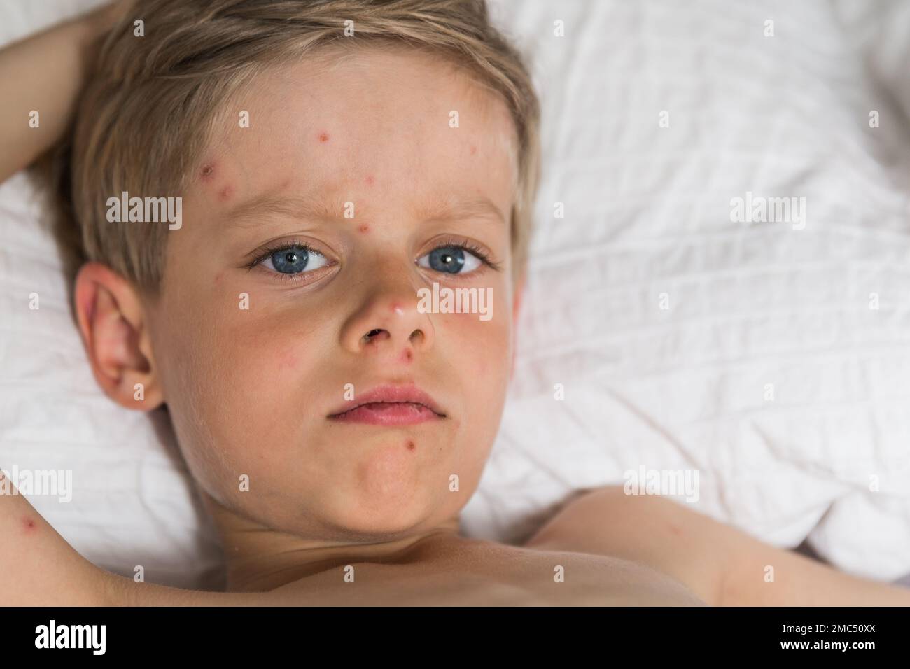 Young toddler with chickenpox. Sick child with chickenpox. Varicella