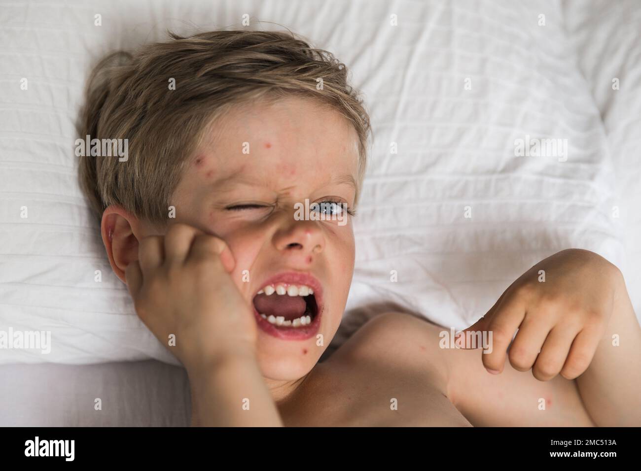 Young toddler with chickenpox. Sick child with chickenpox. Varicella ...
