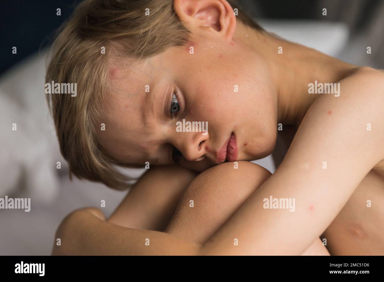 Young toddler with chickenpox. Sick child with chickenpox. Varicella virus or Chickenpox bubble rash on child. Portrait of little boy with pox. Stock Photo