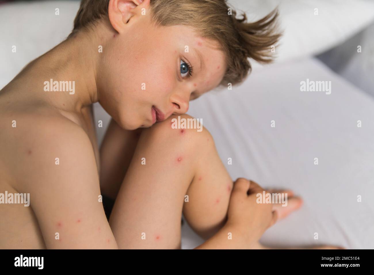 Young toddler with chickenpox. Sick child with chickenpox. Varicella ...