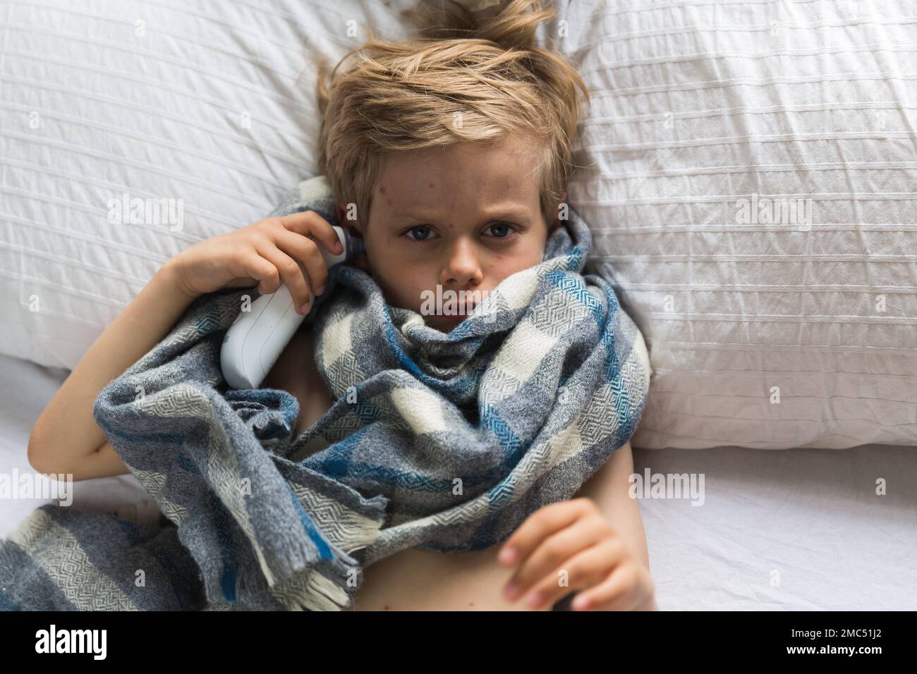 Young toddler with chickenpox. Sick child with chickenpox. Varicella