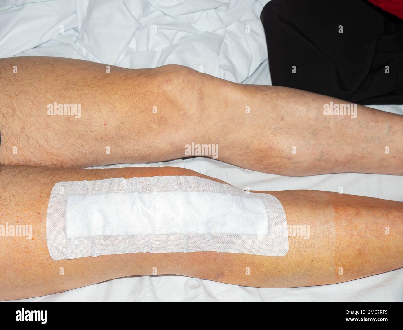 Knee joint replacement, elderly patient under doctor surgical medical