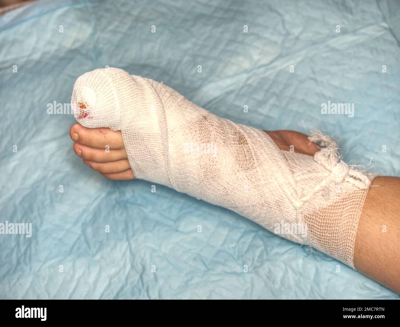 Bloody toe and hurt leg. Wounded children leg with bandaged ankle and