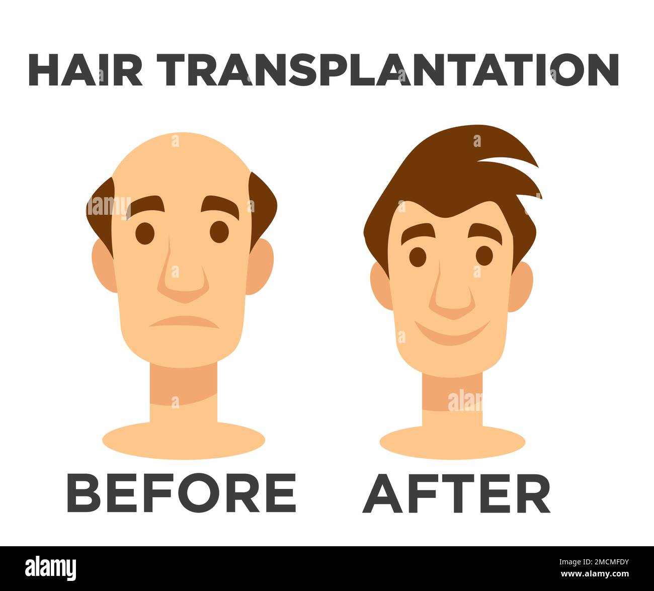 Hair transplantation before and after effect bald man Stock Vector