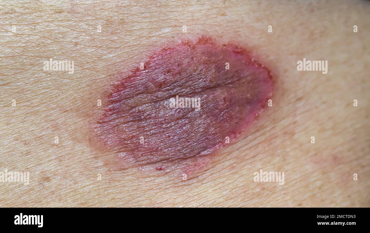 Tinea corporis or ringworm. Itching skin lesions on the abdomen of Asian elderly woman. Stock Photo