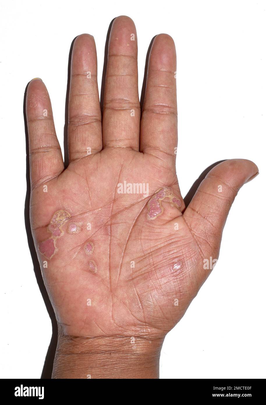Desquamation or peeling skin of hand due to dermatitis. Itchy palm. Isolated on white. Stock Photo