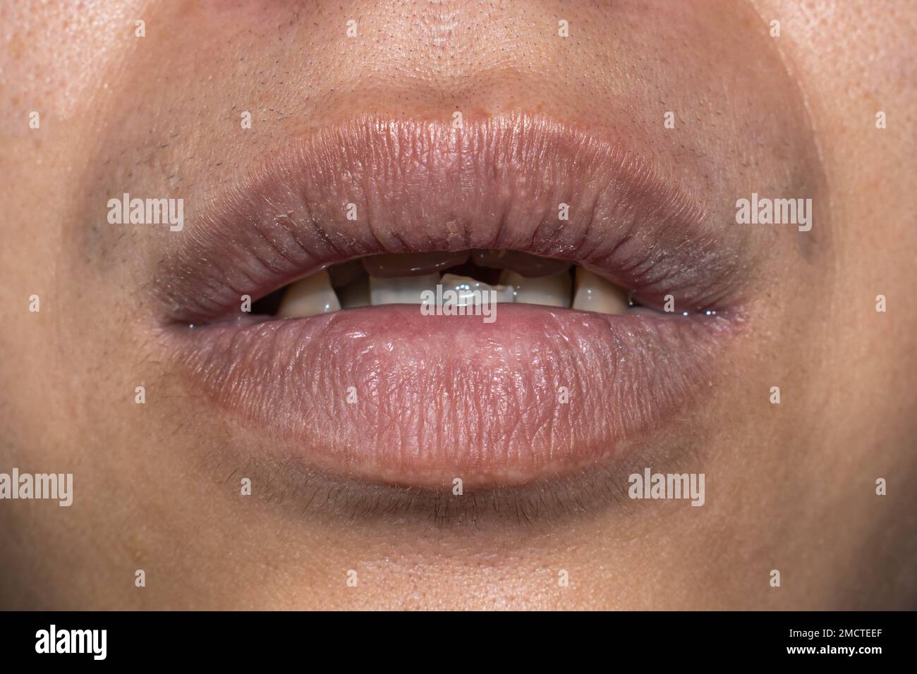 Dry, cracked and dehydrated lips of Asian young man Stock Photo Alamy