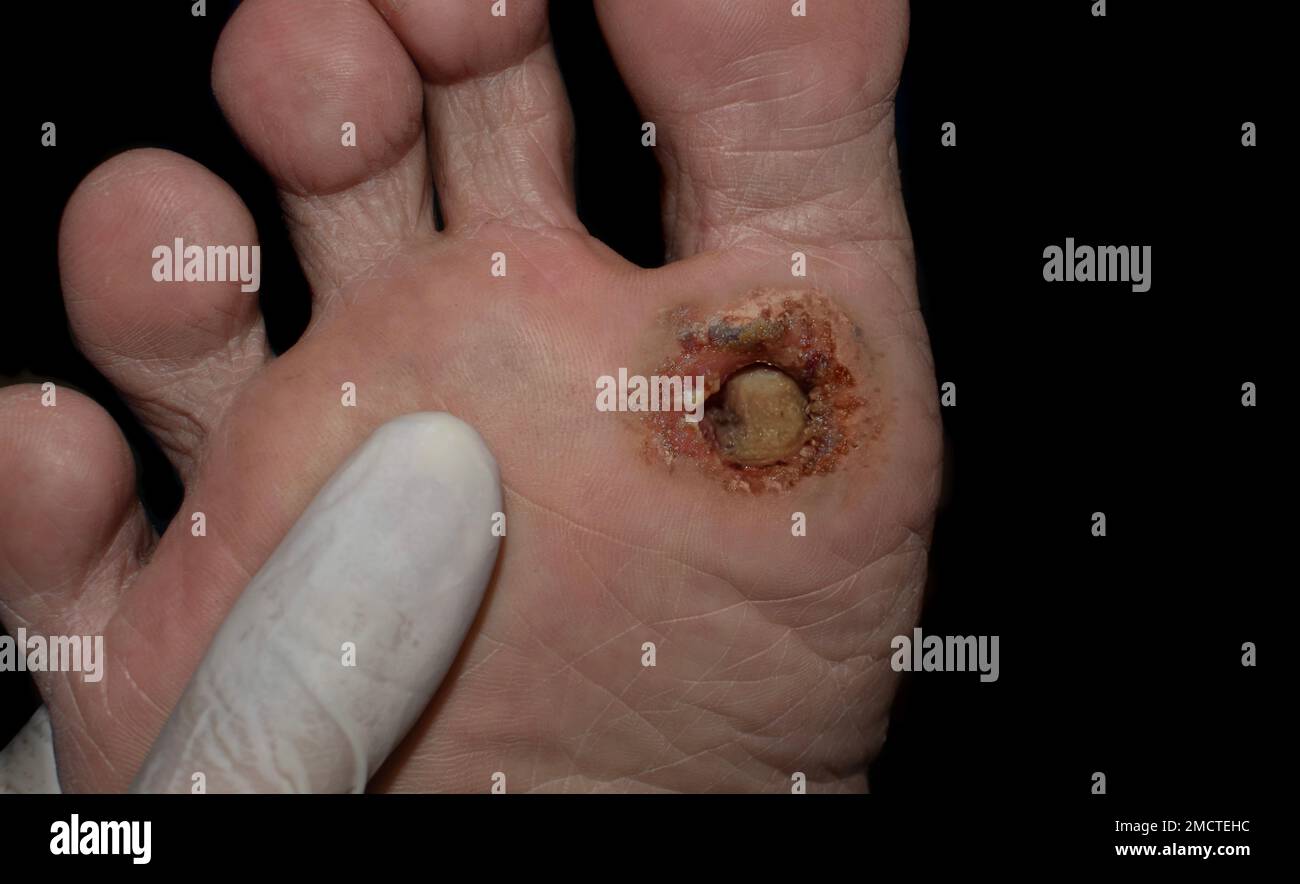 Diabetes foot ulcer in the sole of Asian male patient. Stock Photo