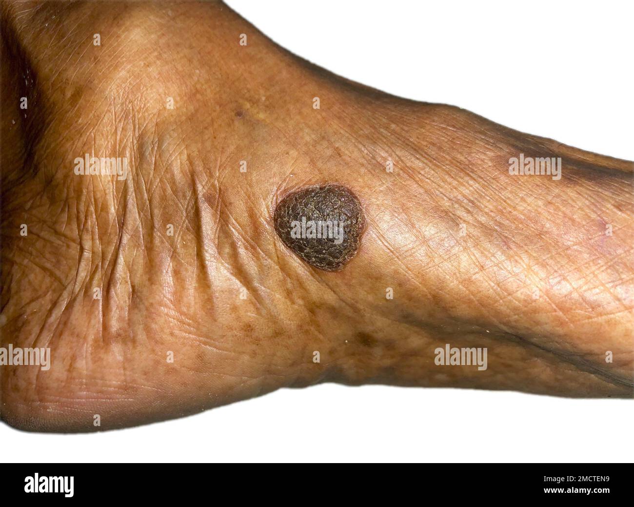 Benign skin growth or single large mole in foot of Southeast Asian elder man. Stock Photo