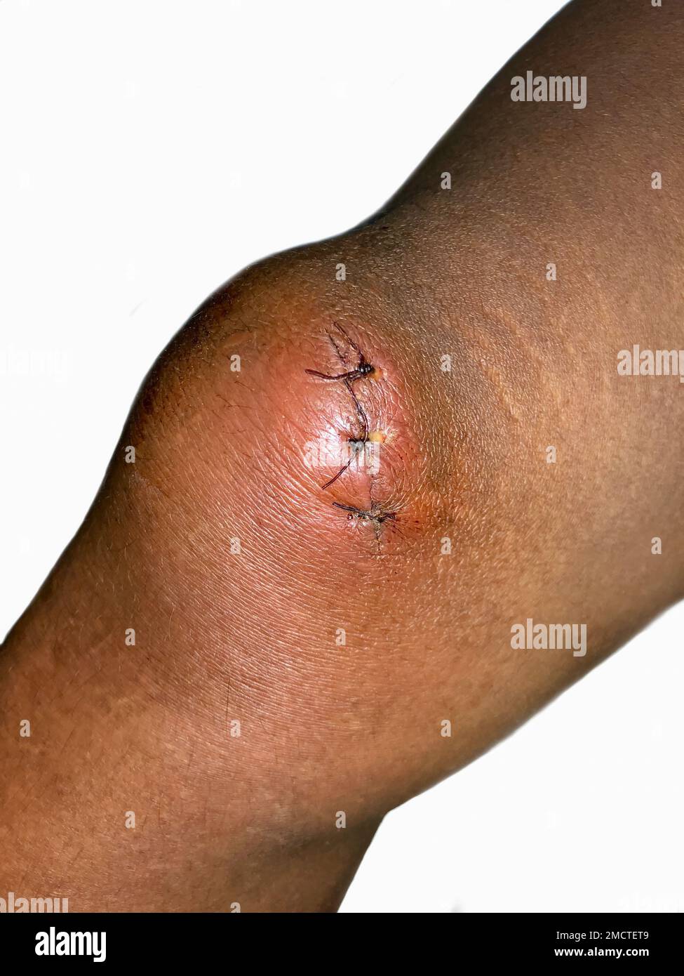 Stitched wound in the knee of Southeast Asian child. Stock Photo