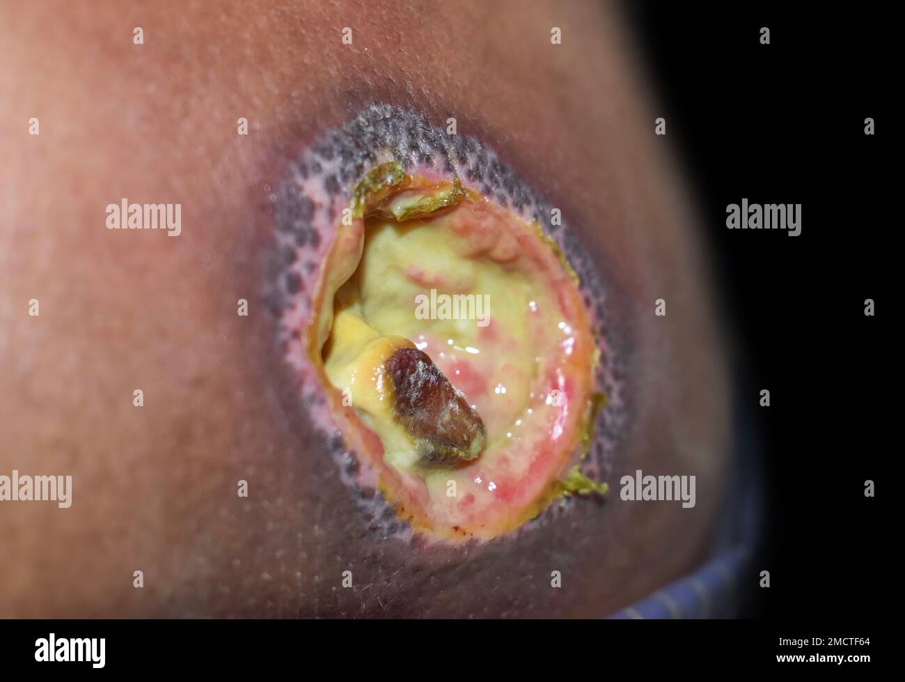 Bed sore aslo called pressure ulcer at tha back. Lateral view. Stock Photo