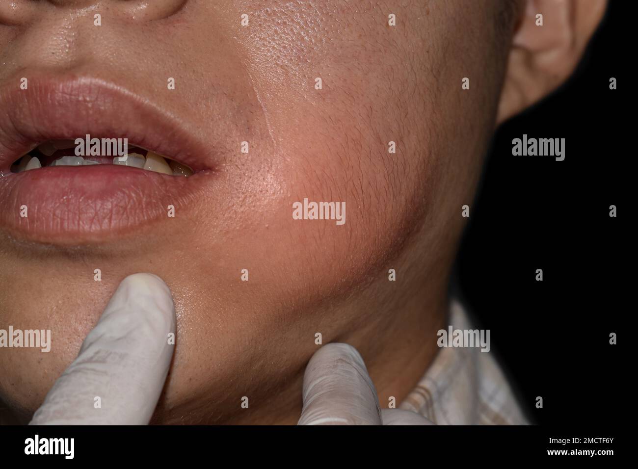 Swelling at the cheek of Asian young man. Abscess formation Stock Photo
