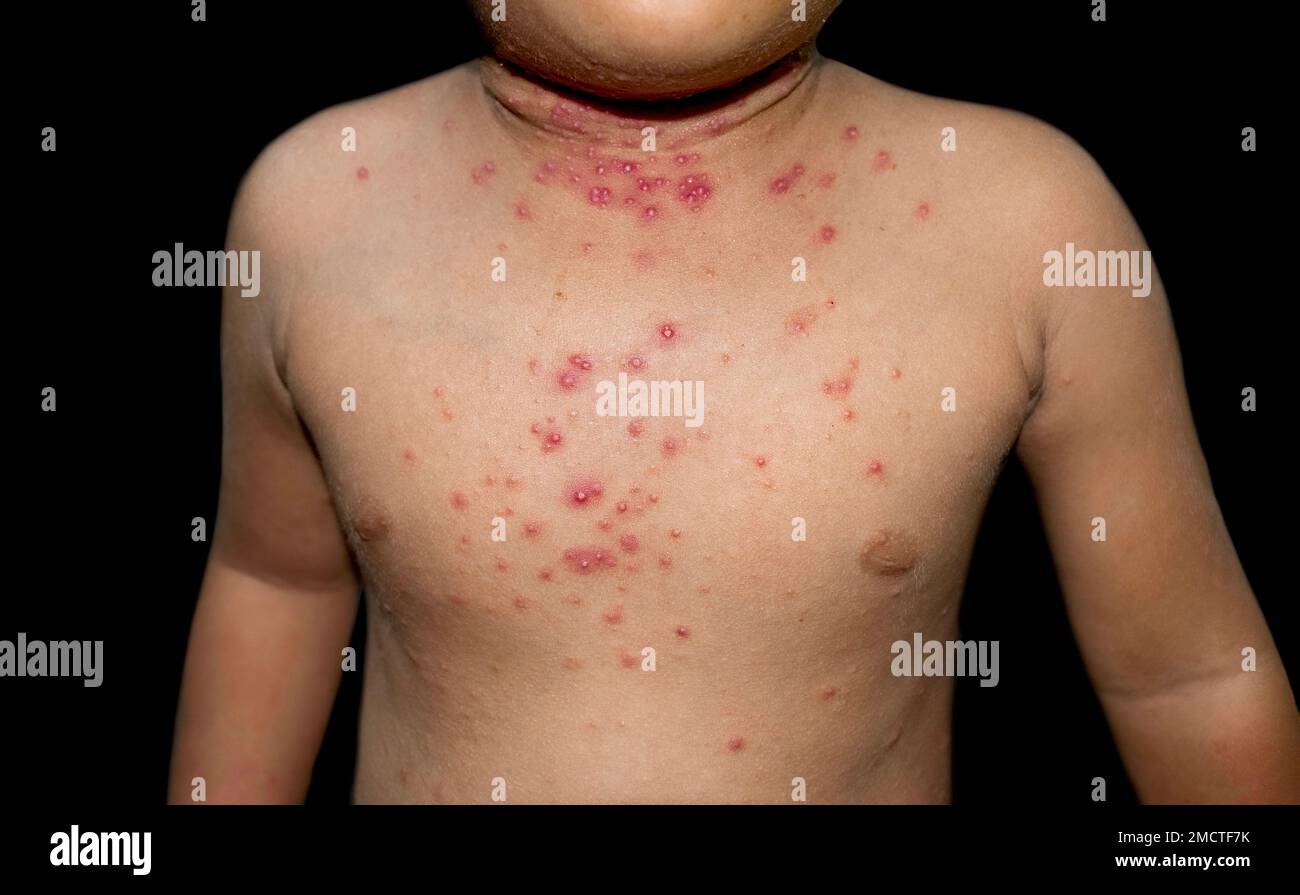 Molluscum contagiosum skin lesions also called water warts of Asian child Stock Photo Alamy