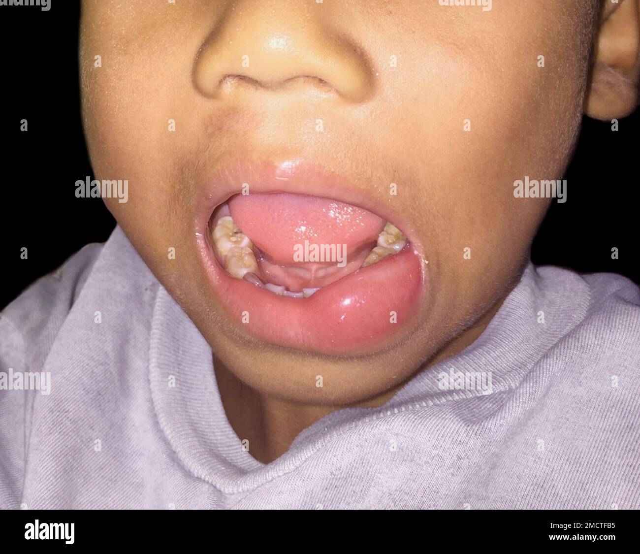 Angioedema at the lower lip of Asian male child. Caused by drug, seafood or chemical allergy and insect bite. Stock Photo