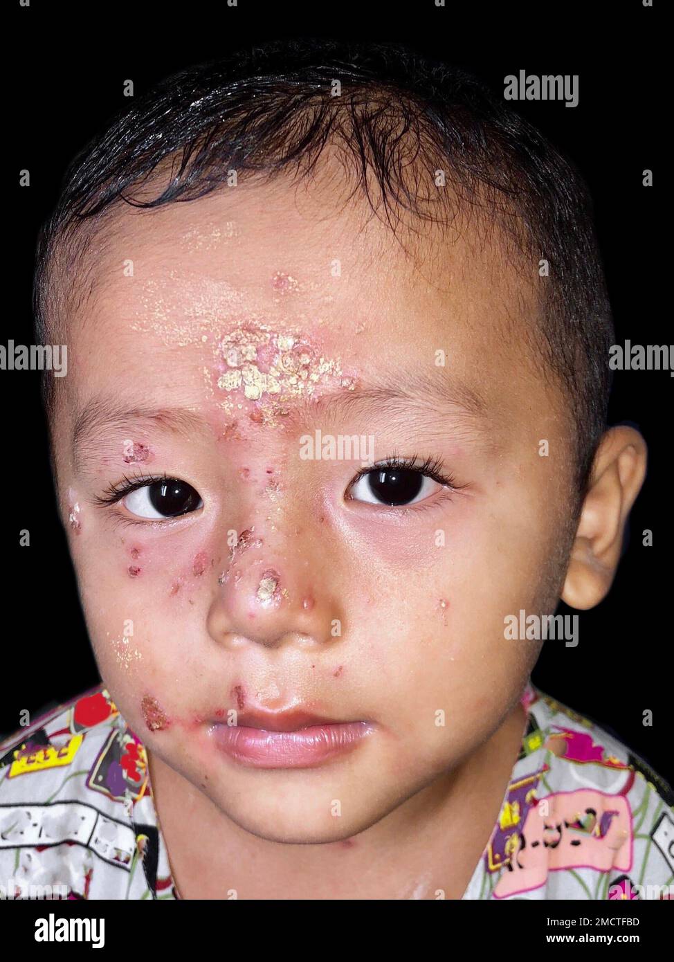 Staphylococcal Skin Infection Called Impetigo Around The Mouth Of Asian