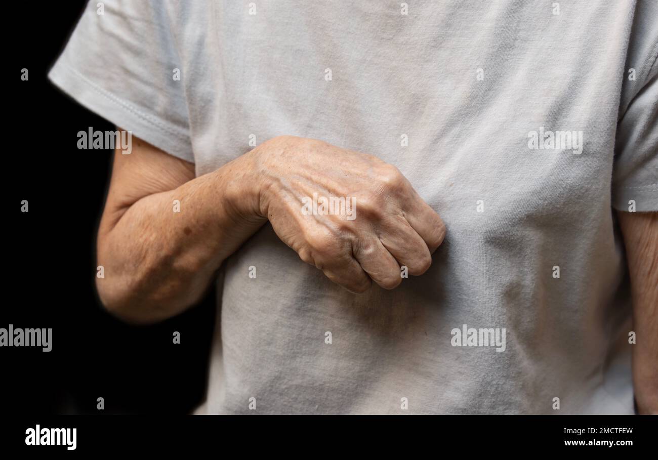 Volkmann contracture in left upper limb of Southeast Asianold  woman. It is a permanent shortening of forearm muscles that gives rise to a clawlike po Stock Photo