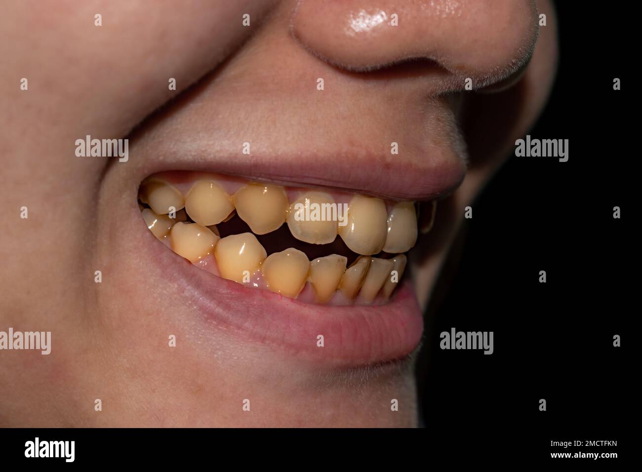 Small teeth with yellow colored tobacco stains. Poor oral hygiene. Stock Photo
