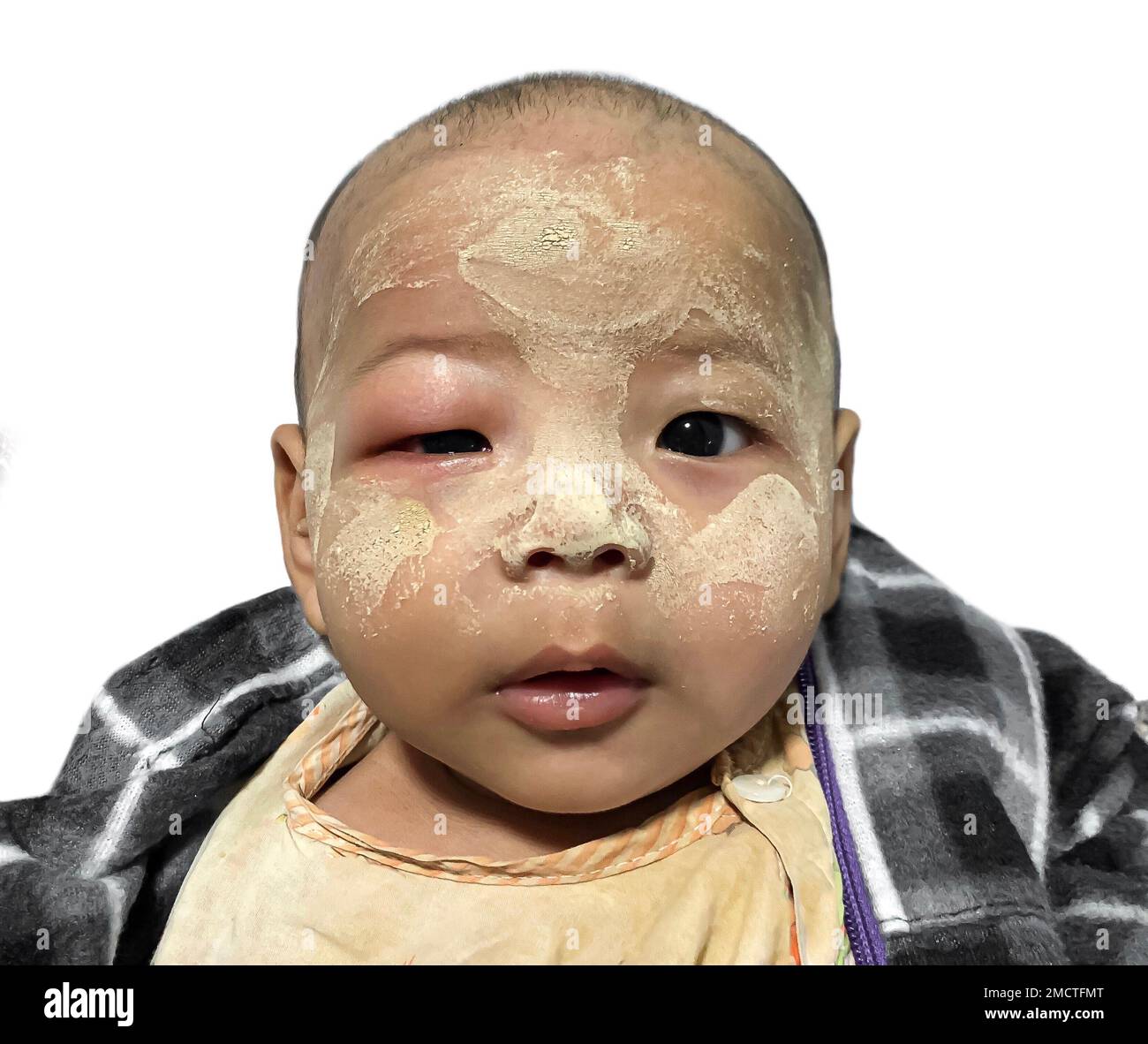 Angioedema at the right eyelid of Southeast Asian child. Caused by drug