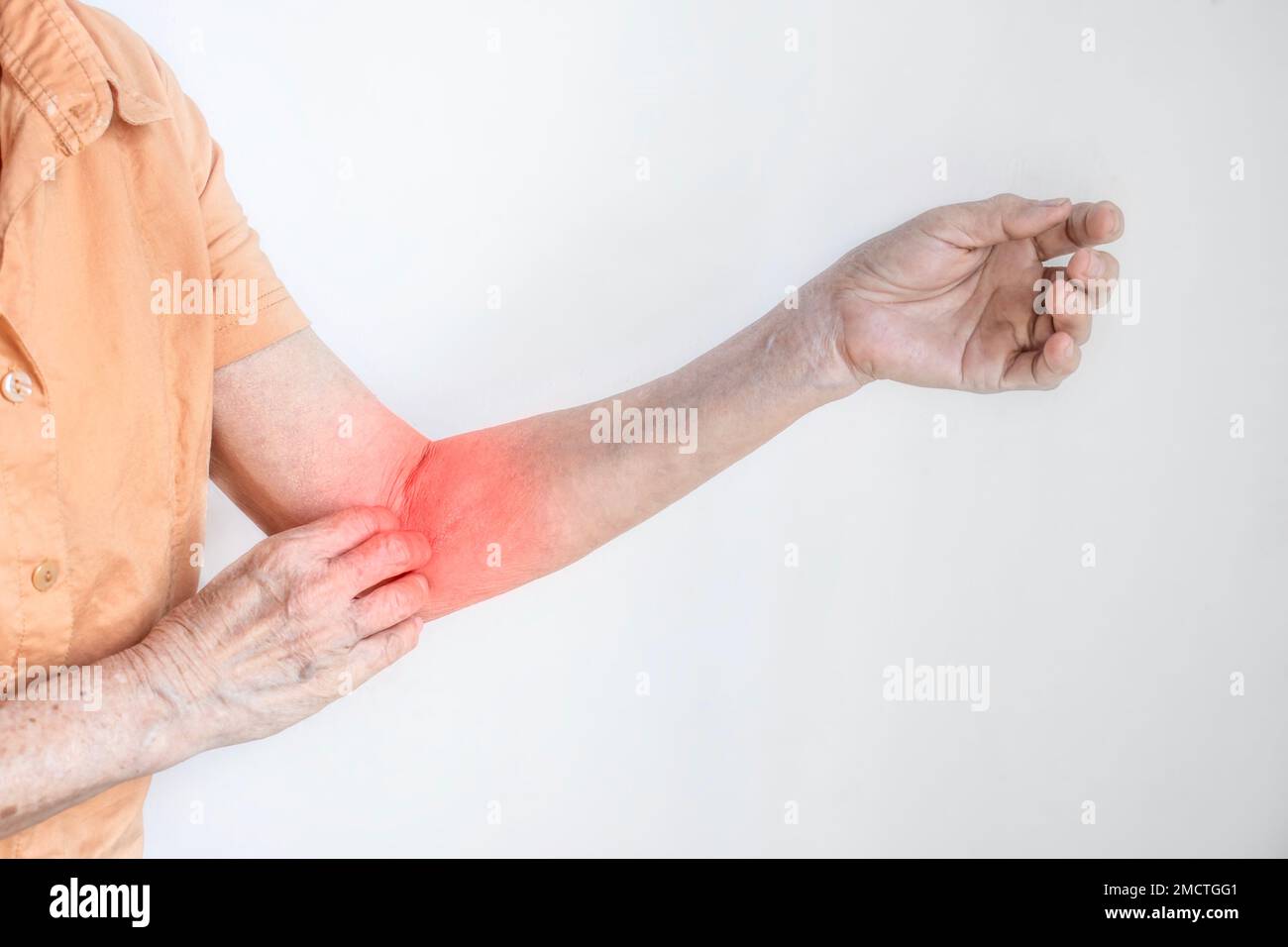 Asian elder woman scratching her arm. Concept of itchy skin diseases such as scabies, fungal infection, eczema, psoriasis, rash, allergy, etc. Stock Photo