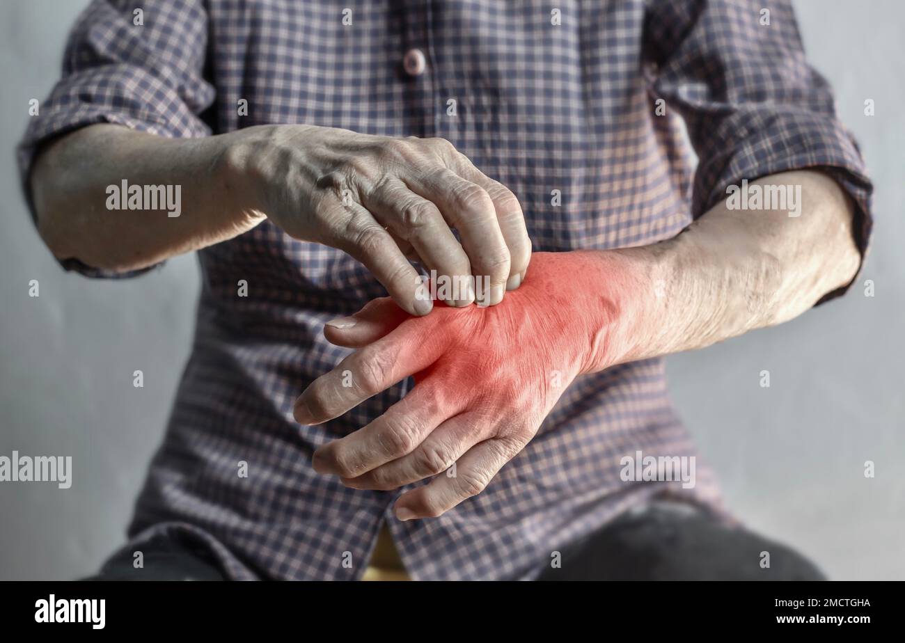 Asian elder woman scratching her hand. Concept of itchy skin diseases such as scabies, fungal infection, eczema, psoriasis, rash, allergy, etc. Stock Photo