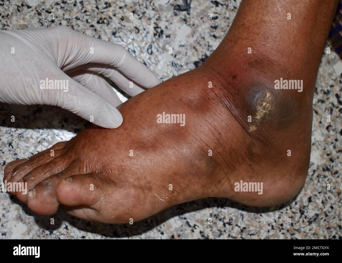 Pitting edema of lower limb. Swollen leg of Asian old man Stock Photo