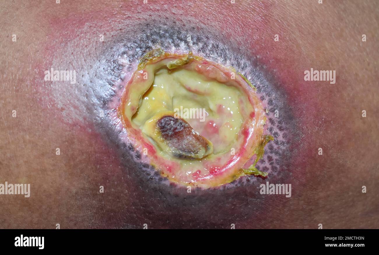 Bed sore aslo called pressure ulcer at tha back. Closeup view. Stock Photo