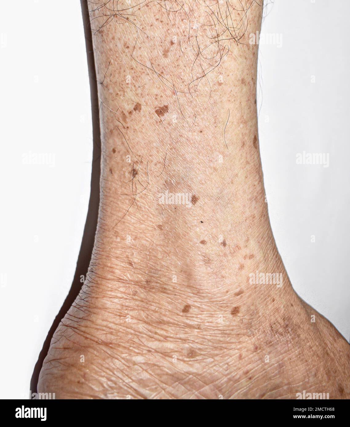 Age spots on the leg of Asian elder man They are brown gray or black Age spots on the leg of Asian elder man They are brown gray or black