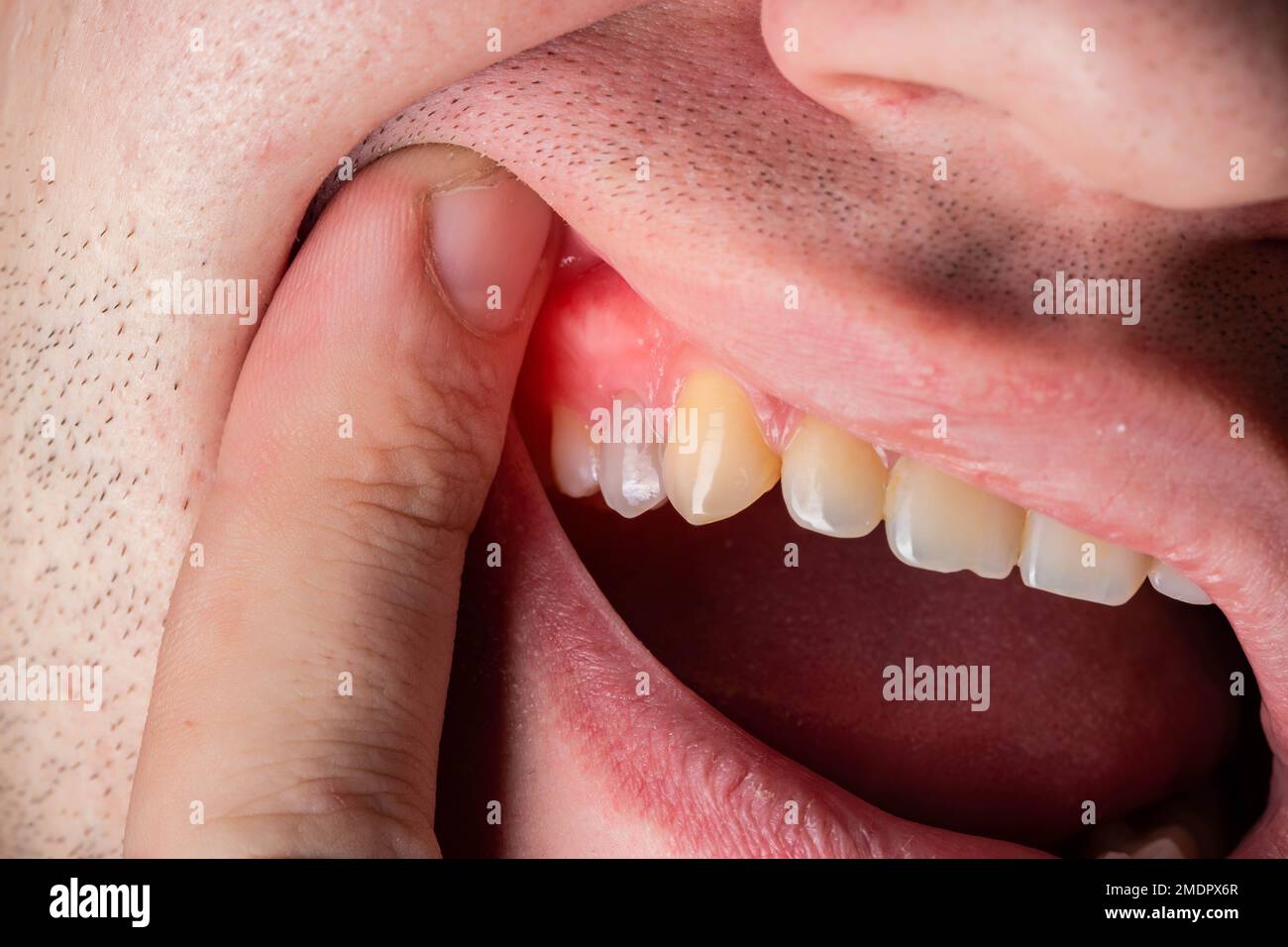 Red and swollen gums in a man. Gum disease gingivitis, gumboil and