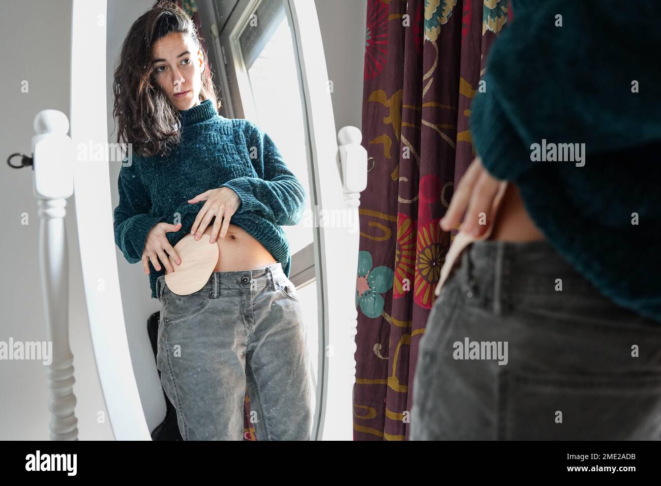 Young woman wearing ileostomy bag - Stock Image - C023/8604 - Science Photo  Library