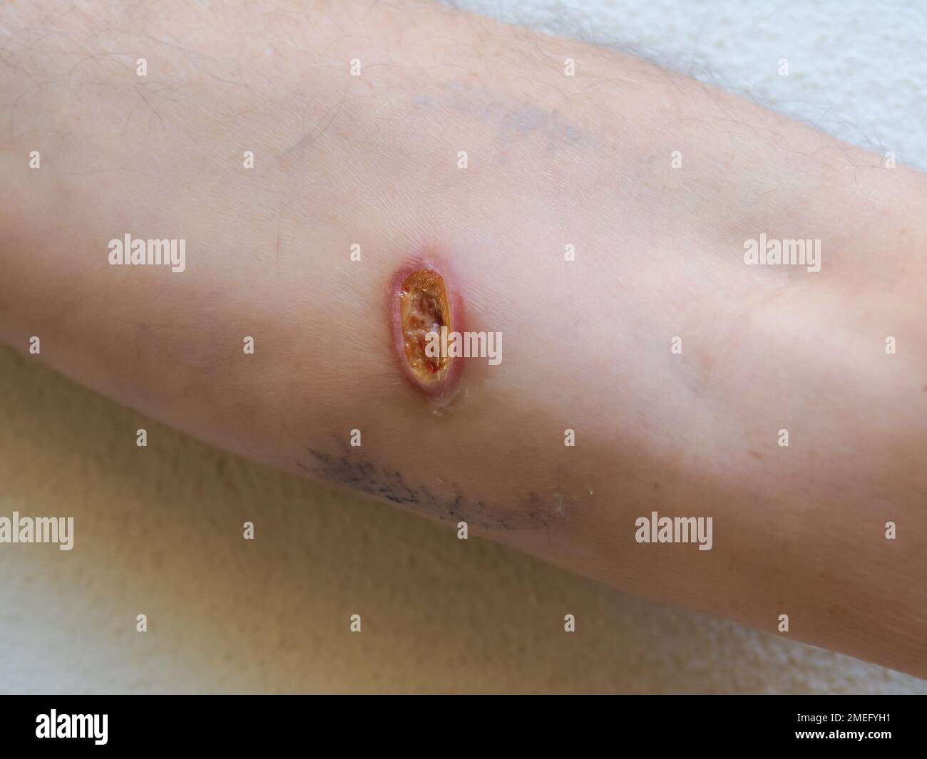 electrical shock entry and exit wounds and burns in 50s adult caucasian