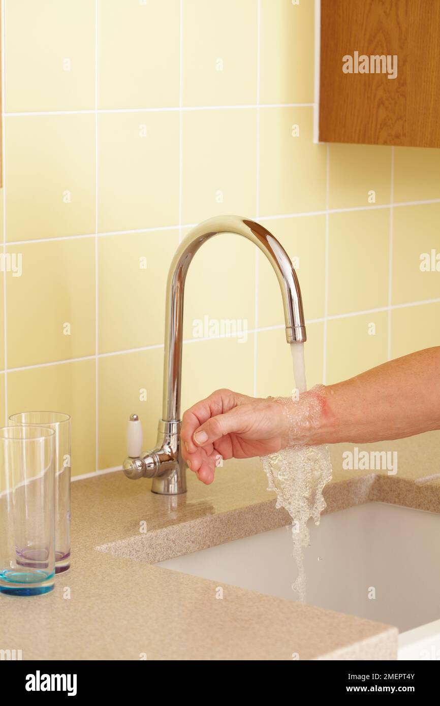Cooling burn on arm by placing under cold tap Stock Photo