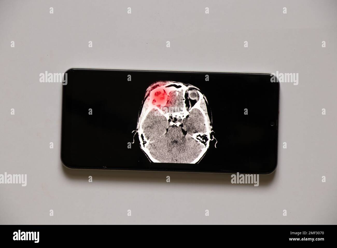 3D computed tomography of the brain with a fracture of the frontal part of the skull after injury on phone screens, mobile application Stock Photo
