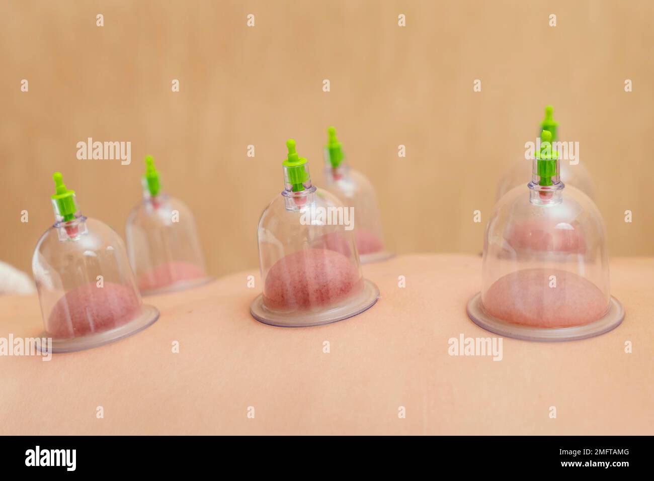 close up patient experiencing cupping therapy. High resolution photo Stock Photo