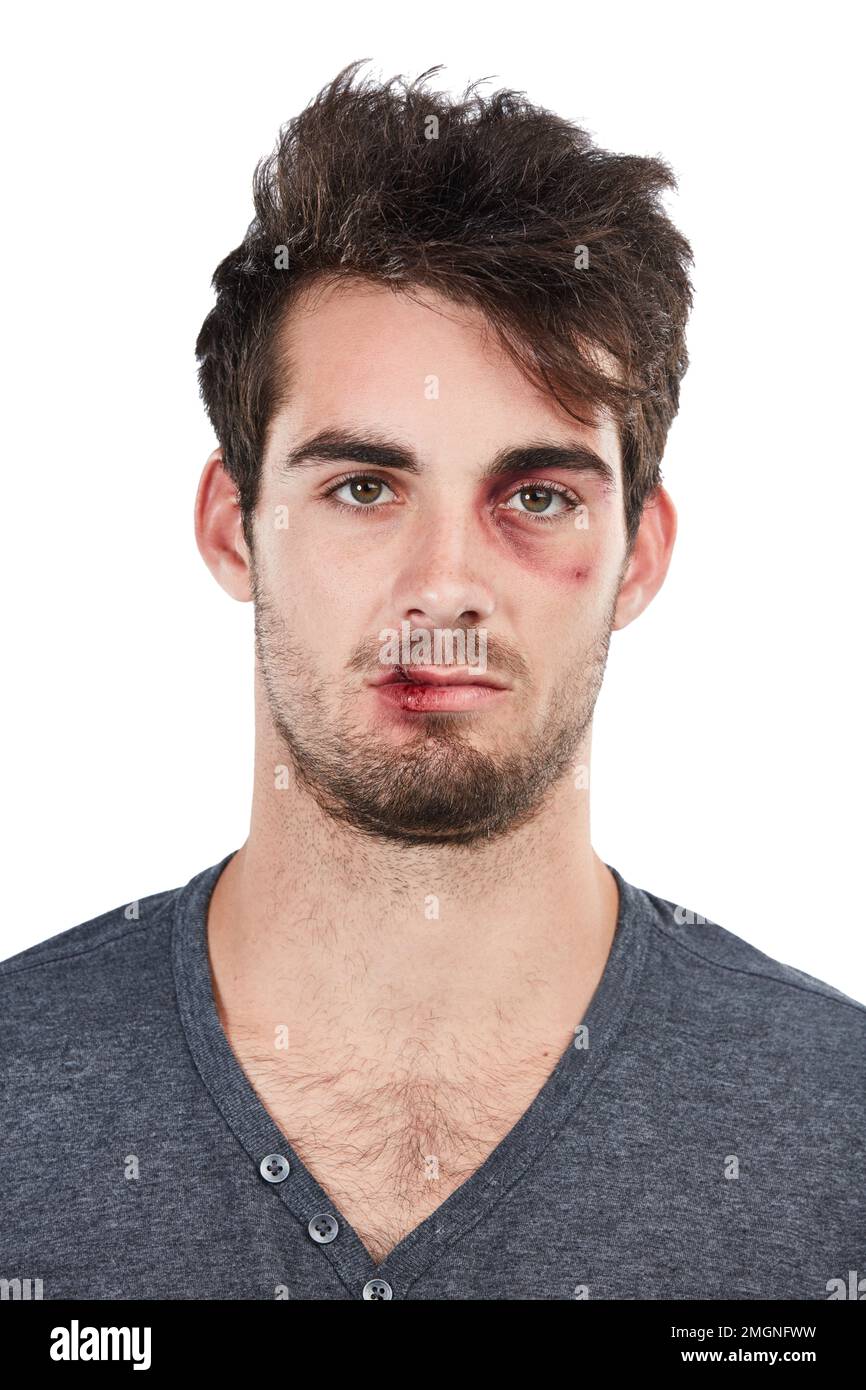 Man, portrait and black eye in studio for fight, conflict and hurt