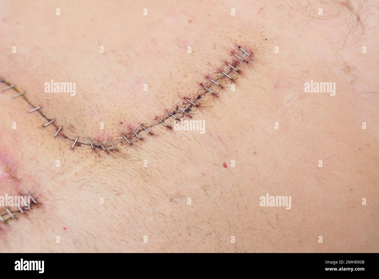 Surgical Staples vs Stitches
