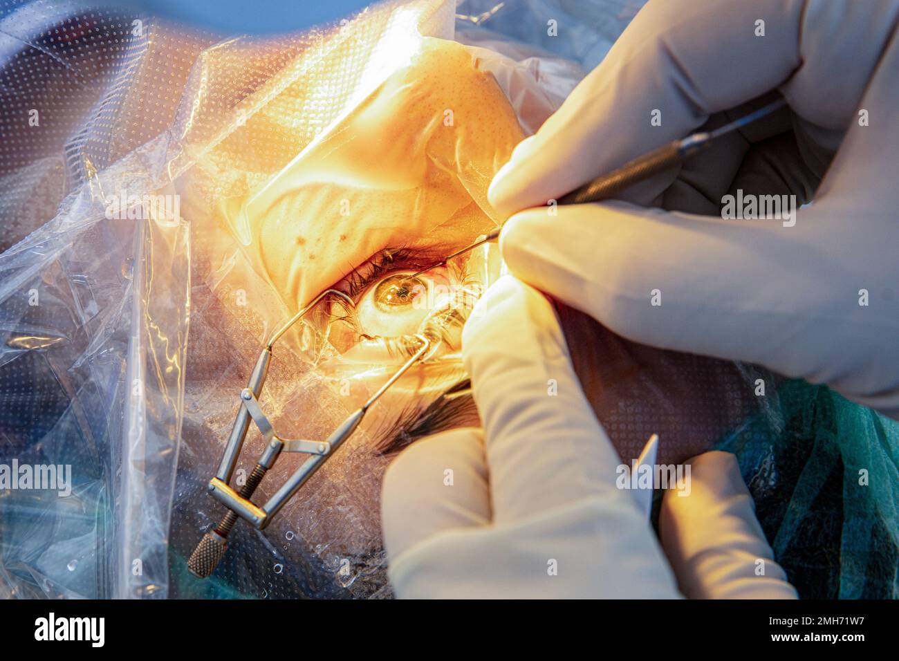 Eye surgery process, treatment of cataract and diopter correction