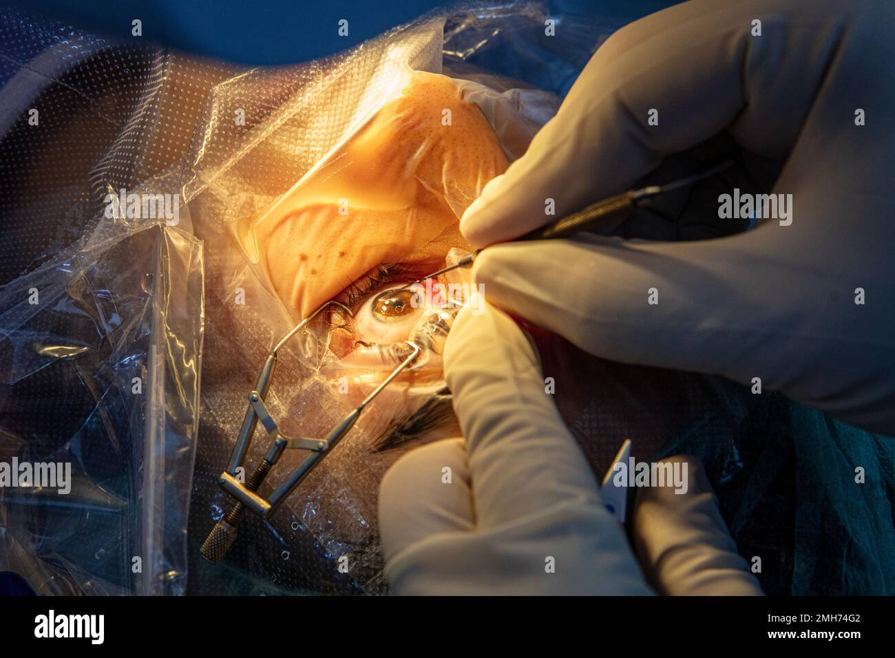 Multifocal eye lens hires stock photography and images Alamy