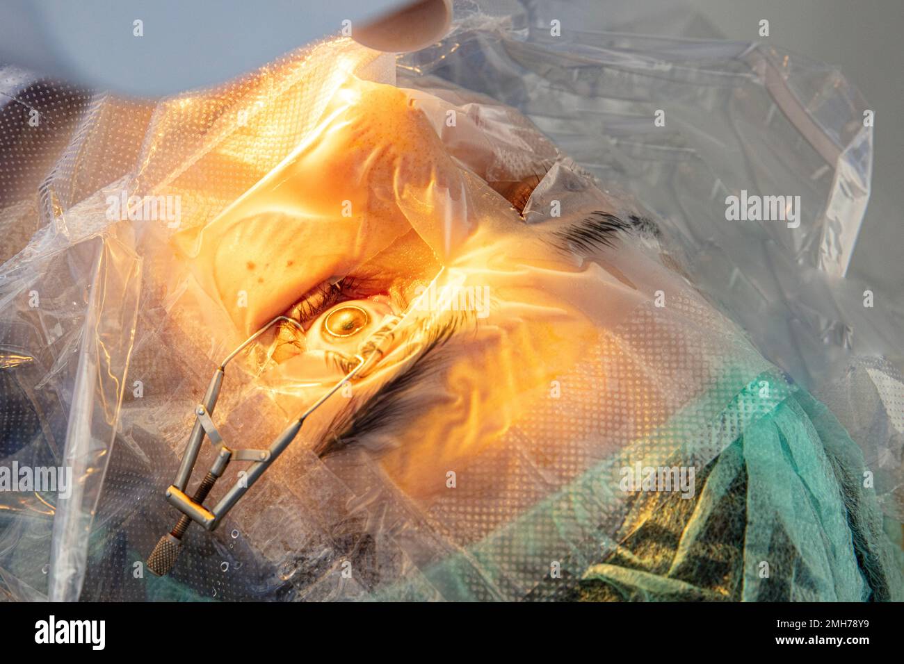 Eye surgery process, treatment of cataract and diopter correction