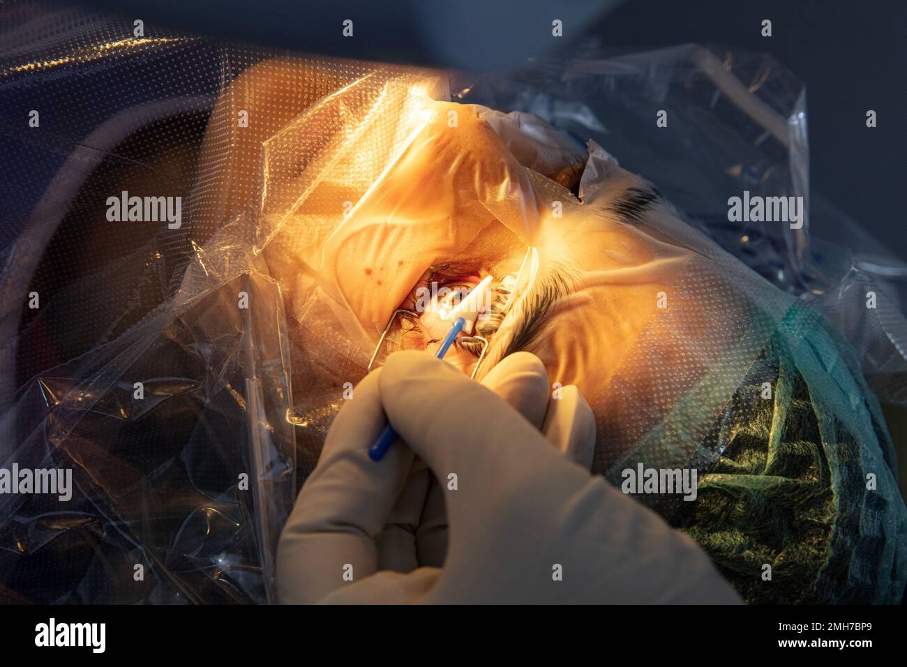 Eye surgery process, treatment of cataract and diopter correction