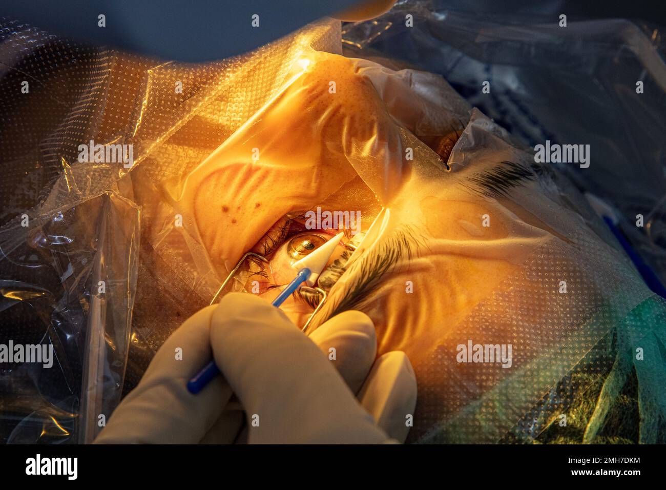 Eye surgery process, treatment of cataract and diopter correction